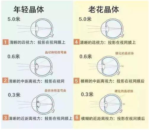 近視就不會(huì)老花了嗎？